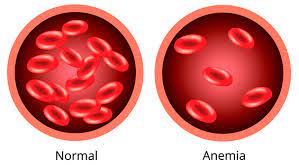 Ilustración de anemia ferropénica