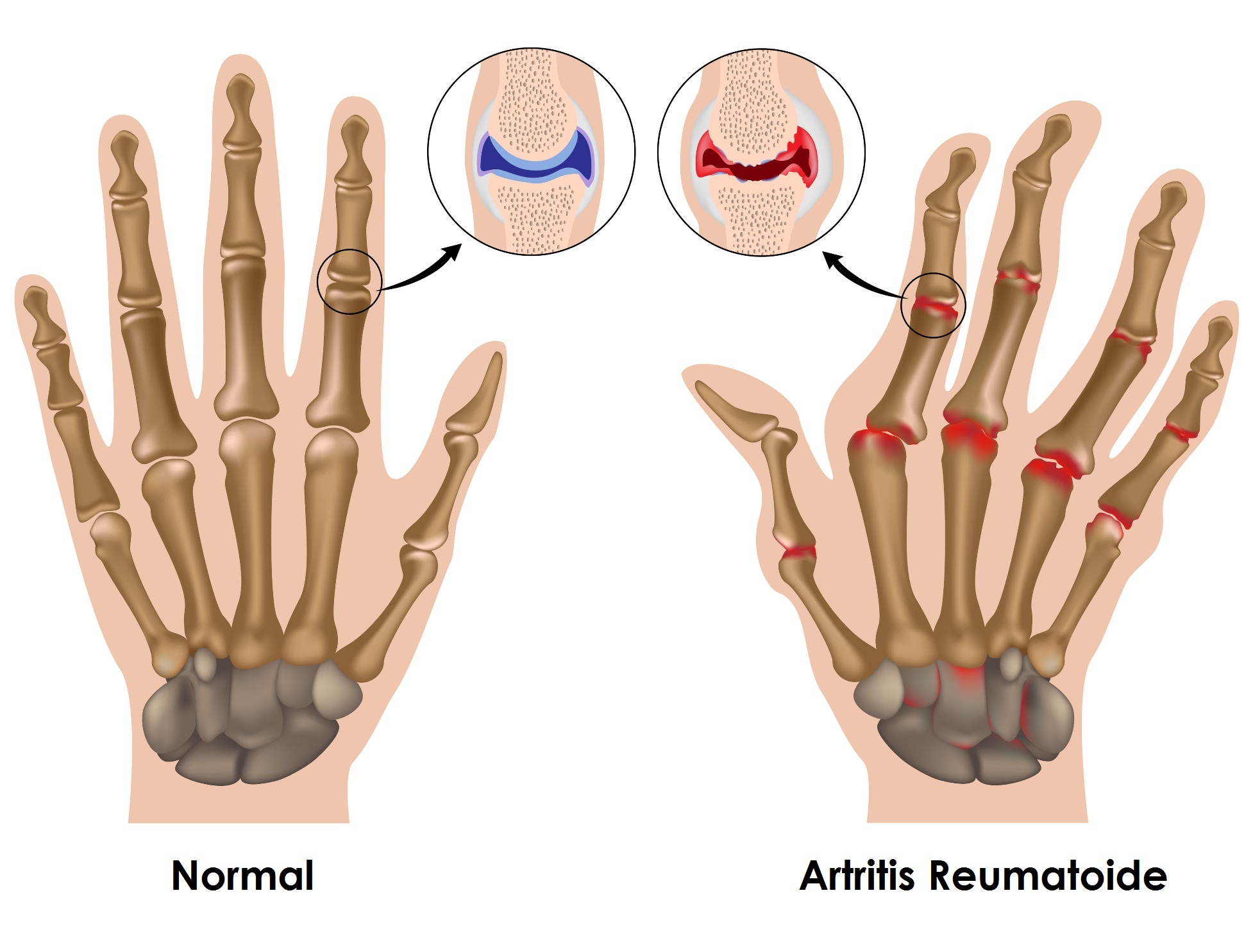 Ilustración de artritis reumatoide