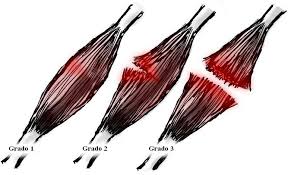 Desgarro muscular