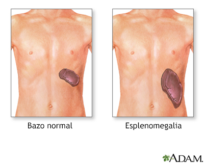 Diagnóstico de esplenomegalia