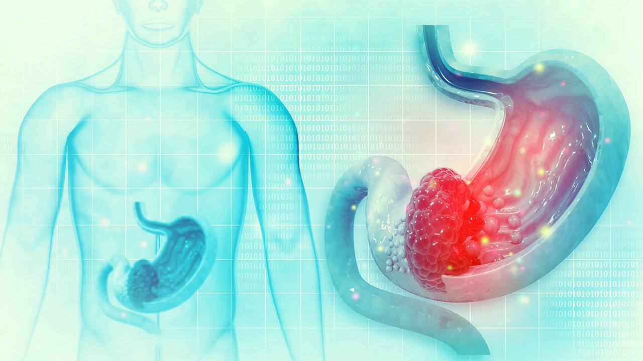 Gastritis erosiva