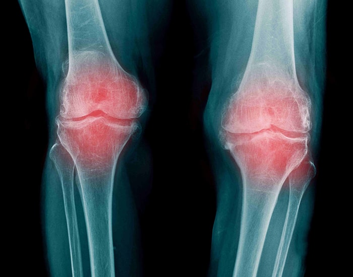 Dolor articular por artrosis